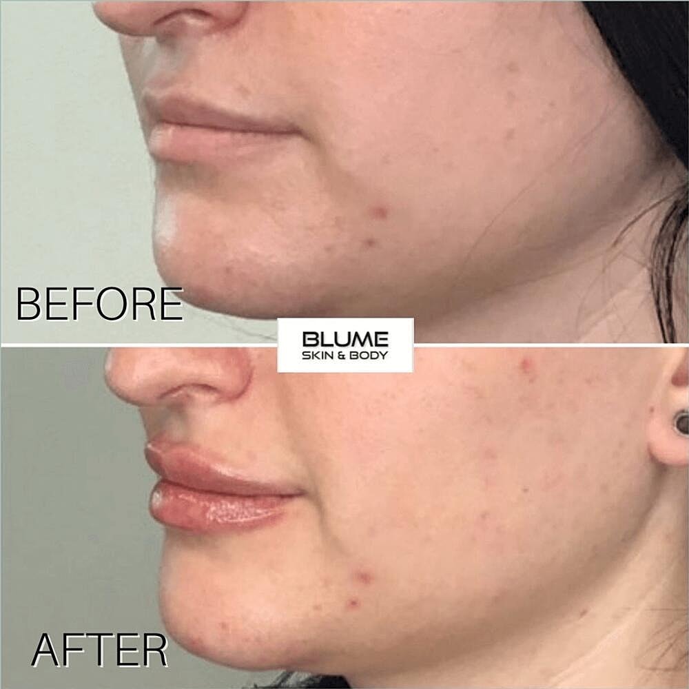 Dermal Fillers Before & After