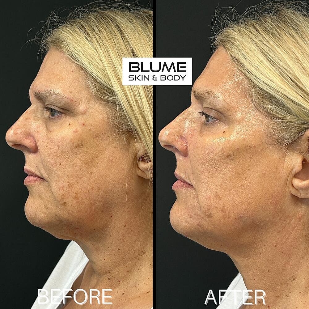 Dermal Fillers Before & After