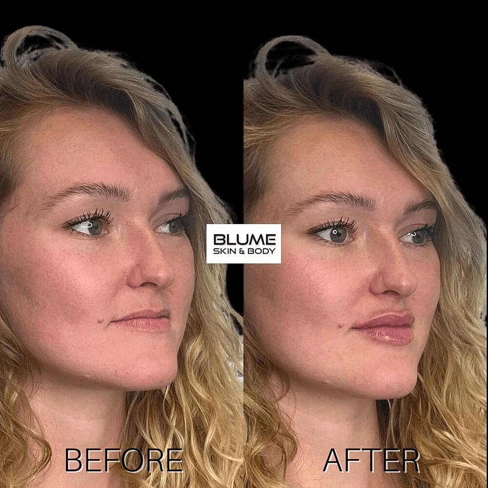 Dermal Fillers Before & After