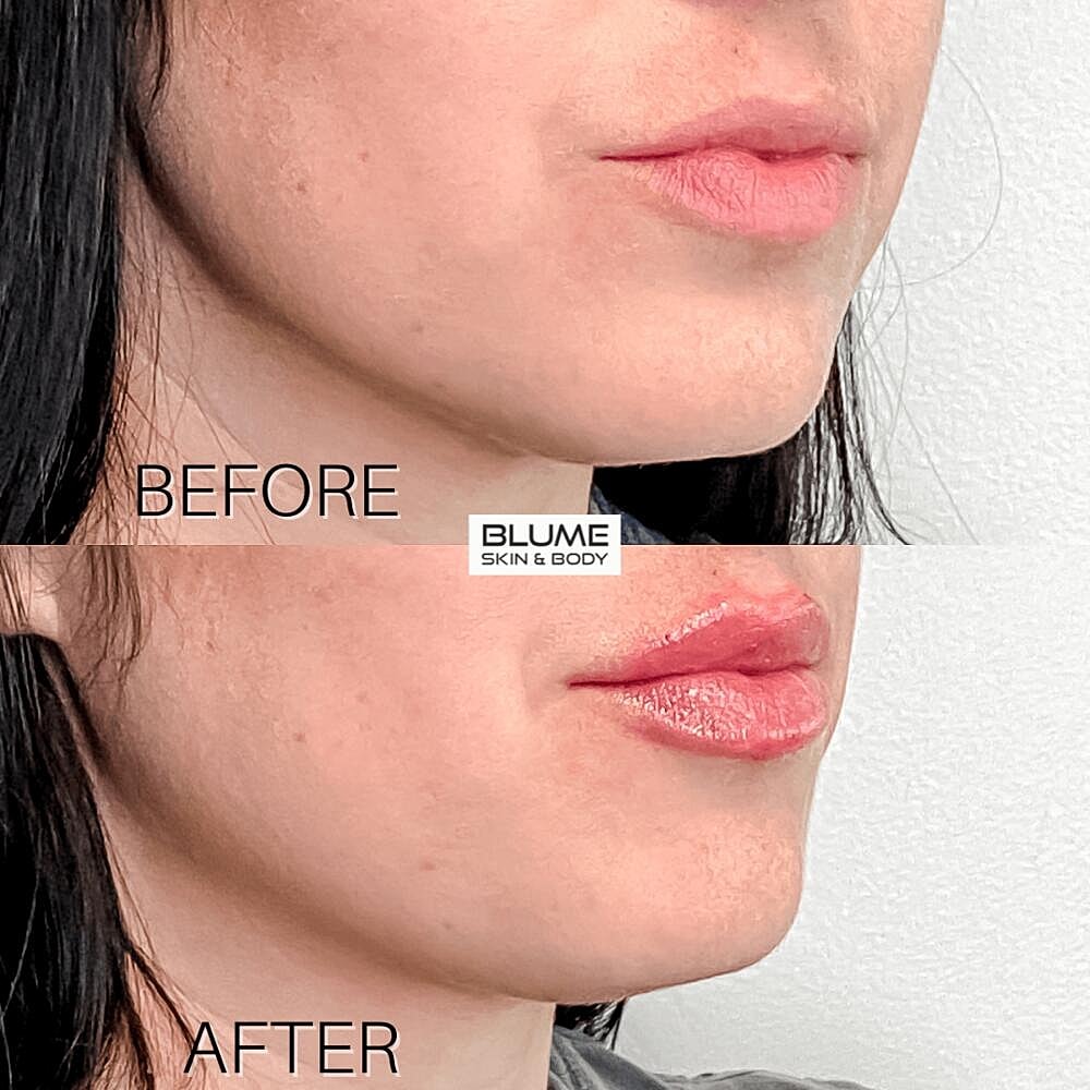 Dermal Fillers Before & After