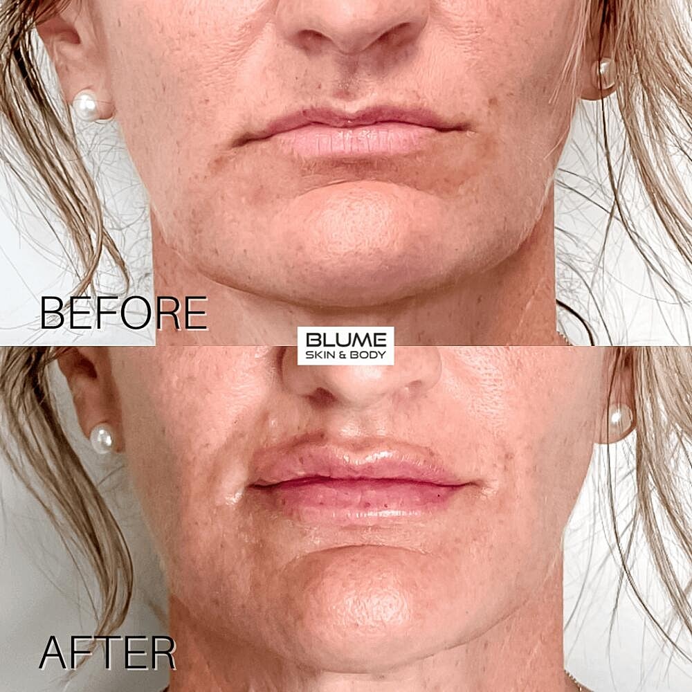 Dermal Fillers Before & After