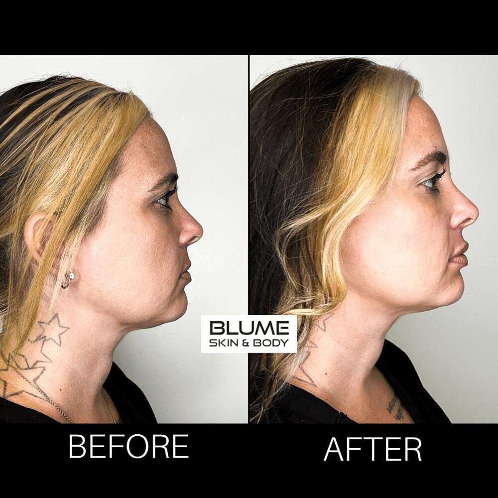 Dermal Fillers Before & After