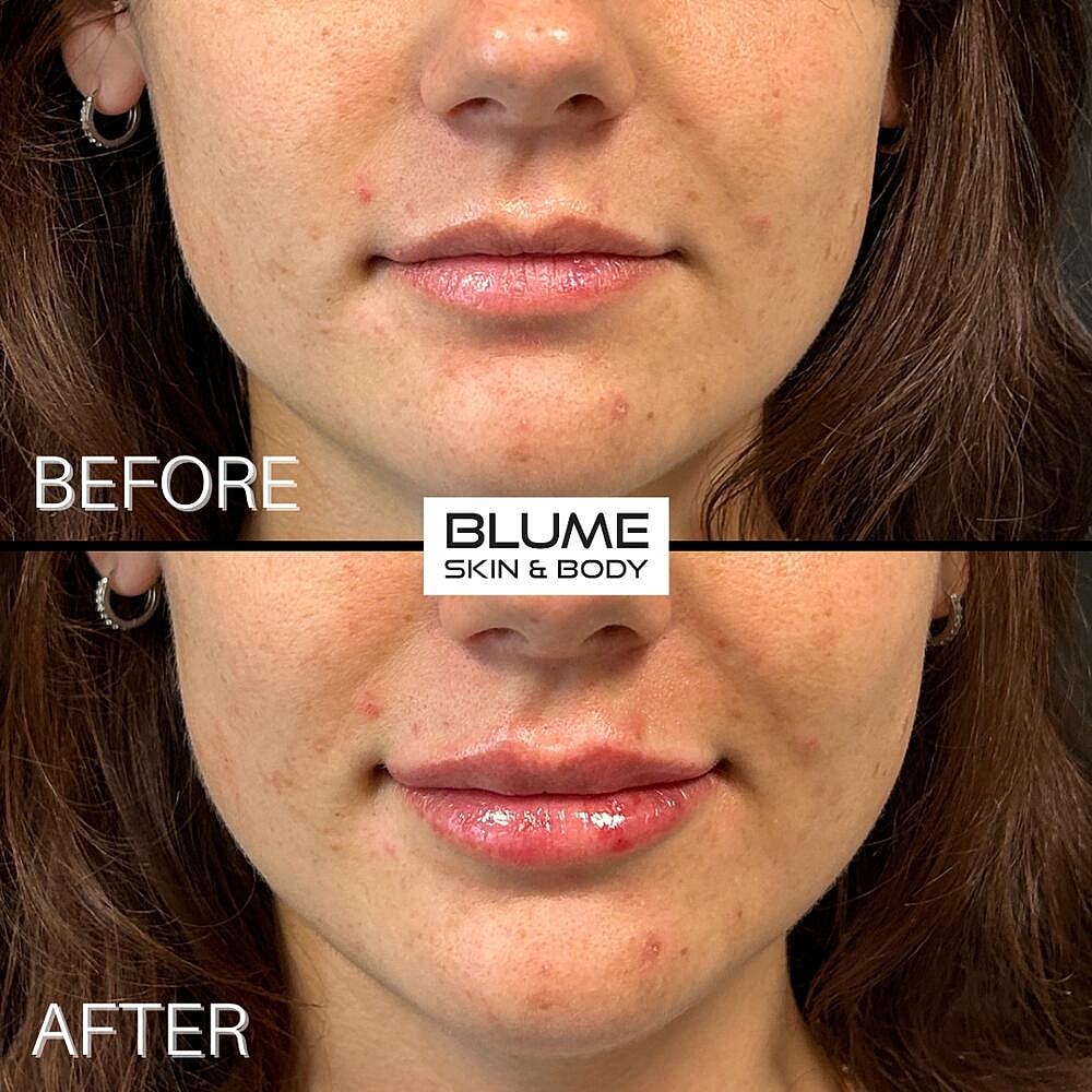 Dermal Fillers Before & After