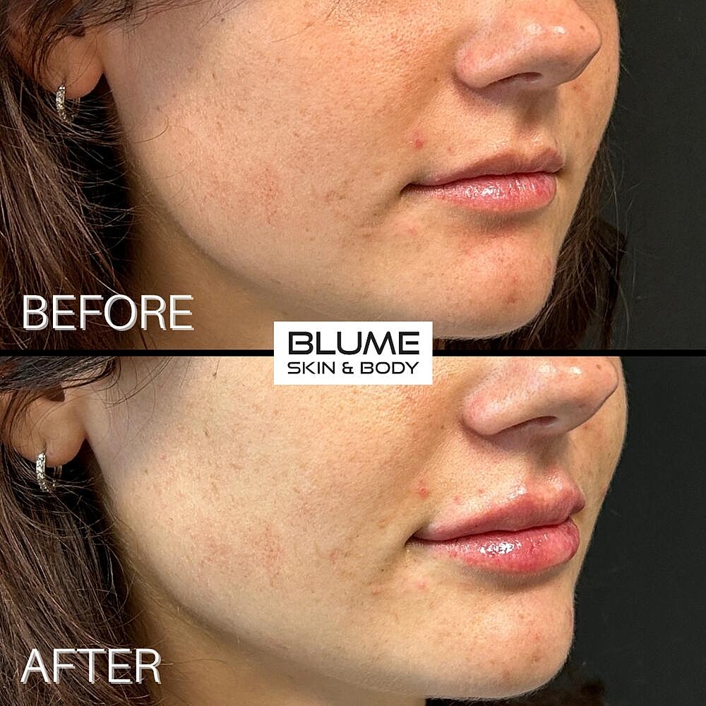 Dermal Fillers Before & After