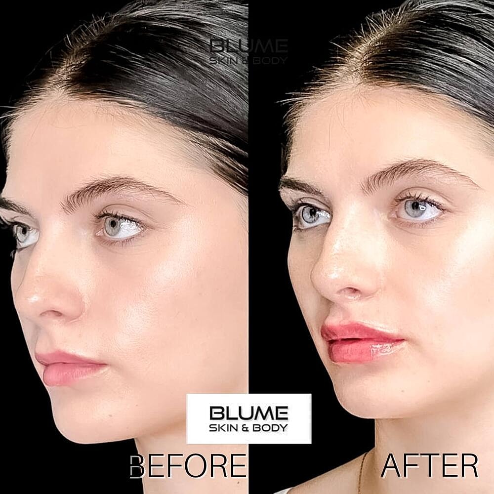 Dermal Fillers Before & After