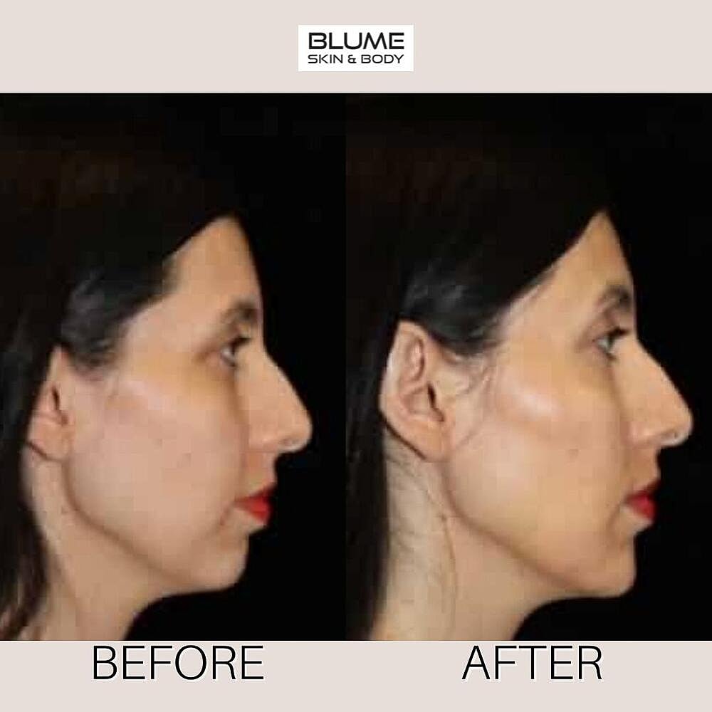 Dermal Fillers Before & After