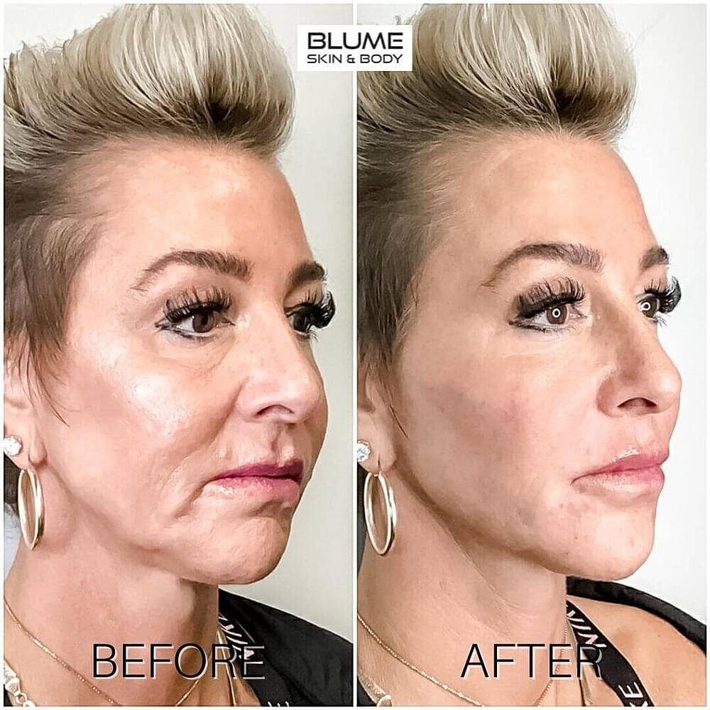 Dermal Fillers Before & After