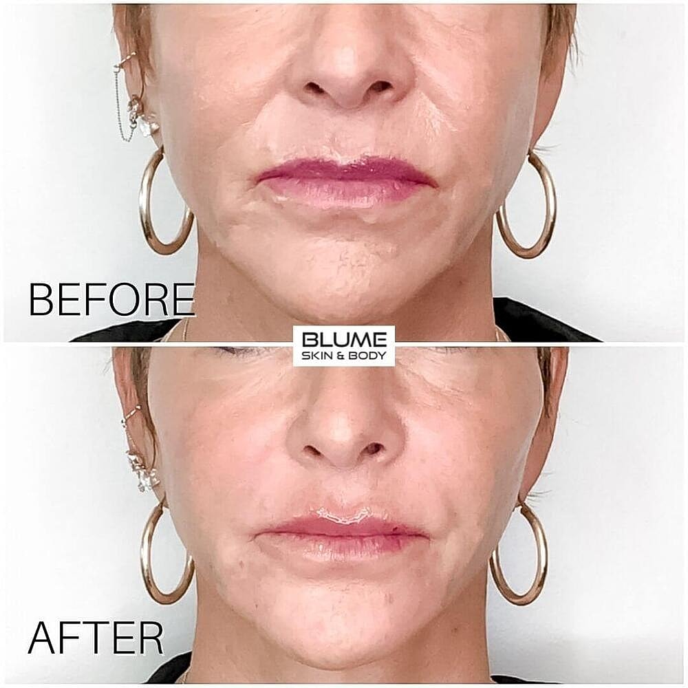 Dermal Fillers Before & After
