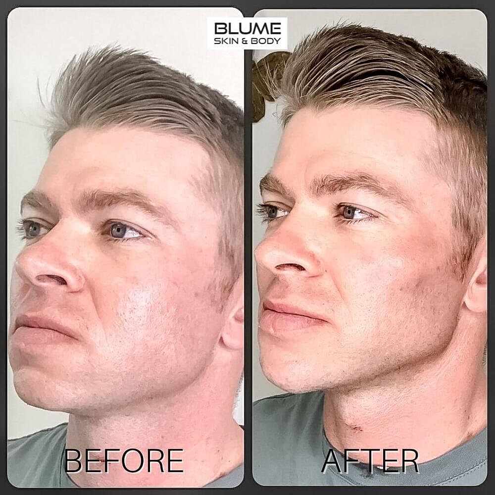 Dermal Fillers Before & After