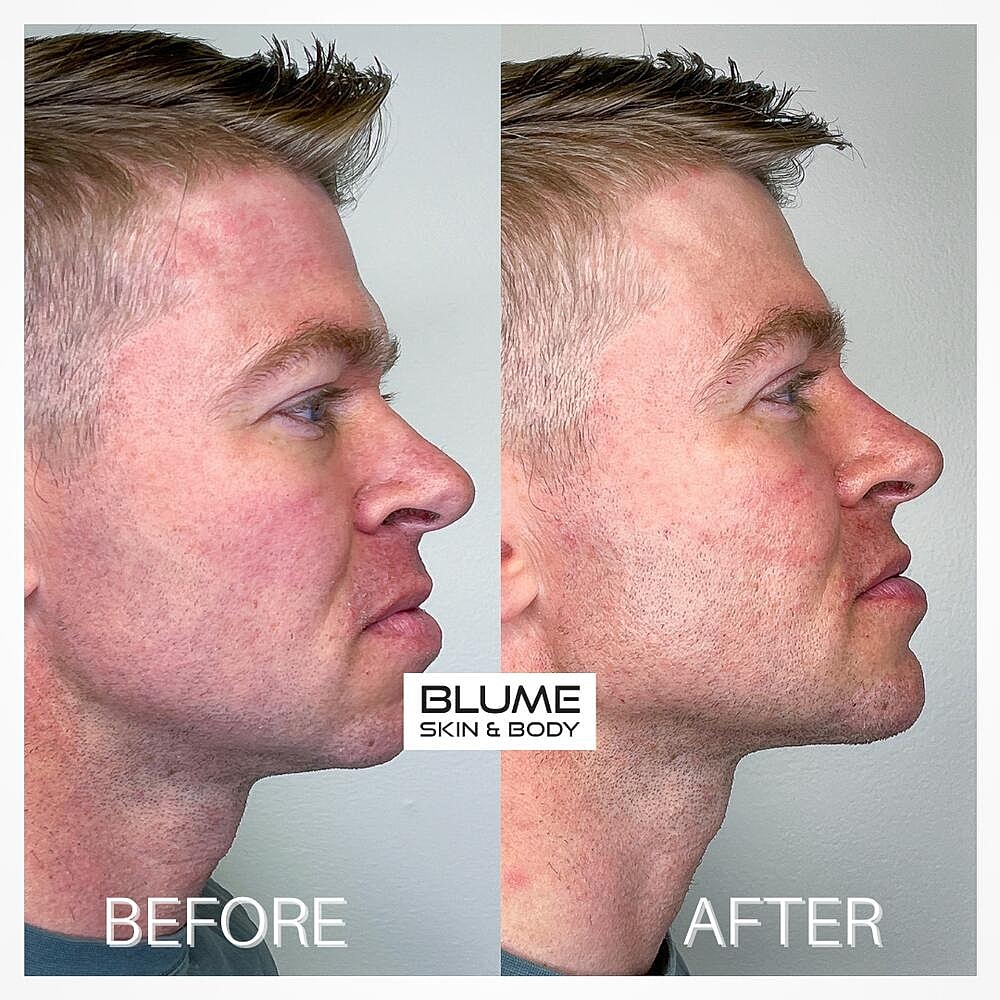 Dermal Fillers Before & After