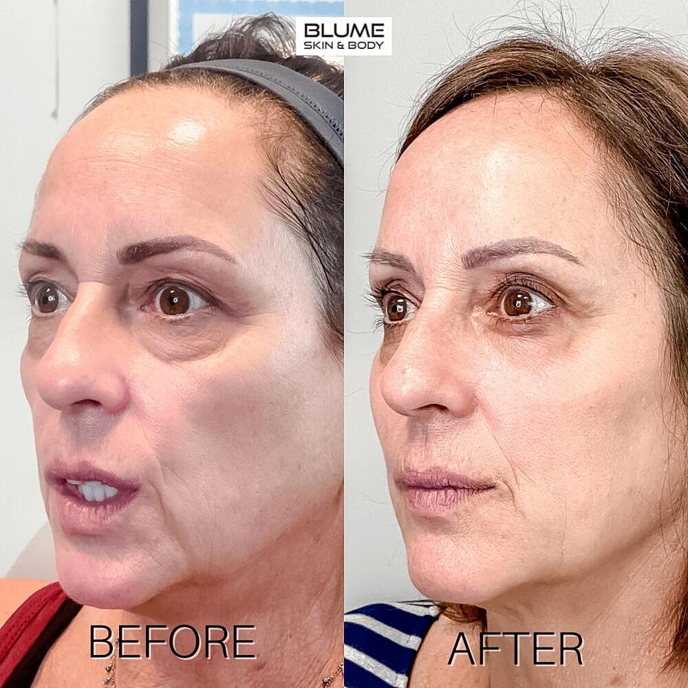 Dermal Fillers Before & After