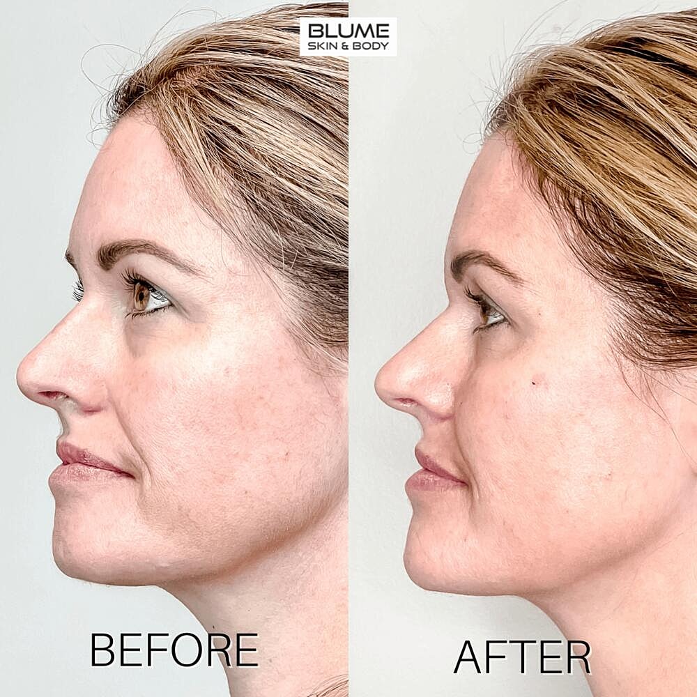 Dermal Fillers Before & After