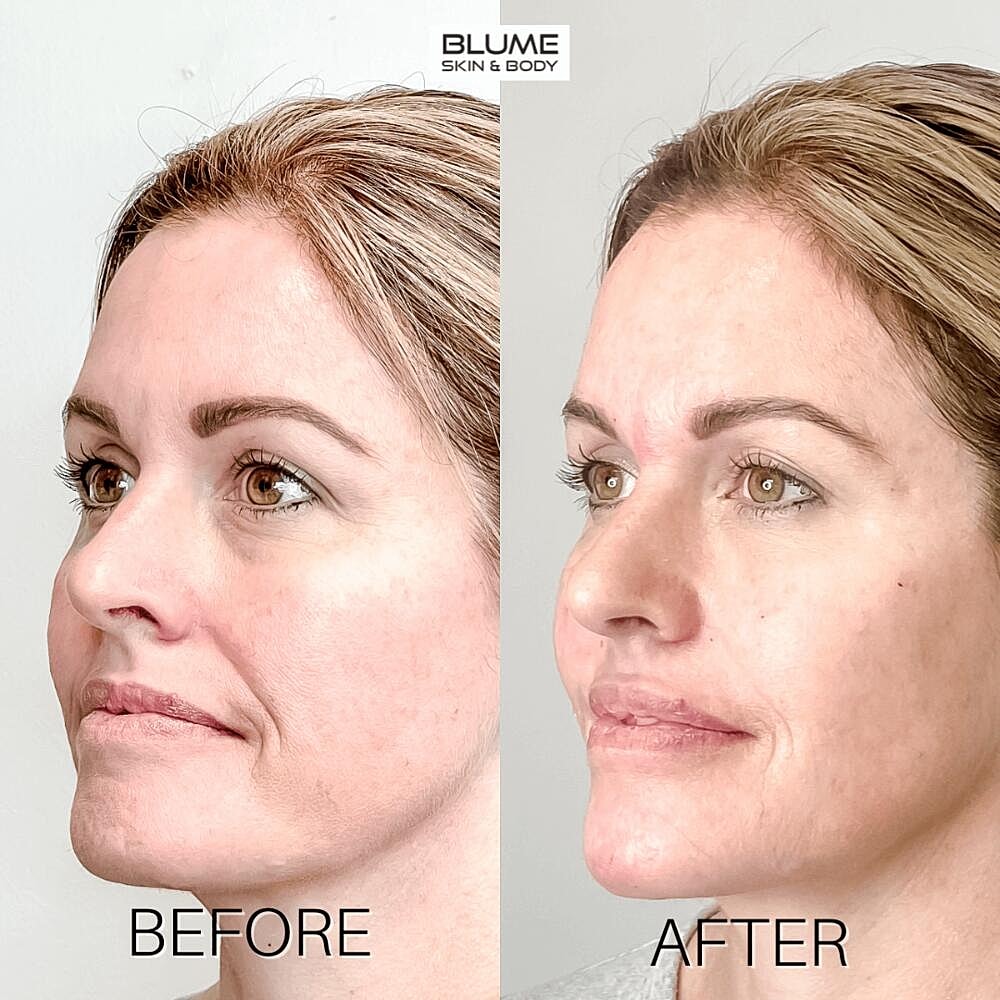 Dermal Fillers Before & After
