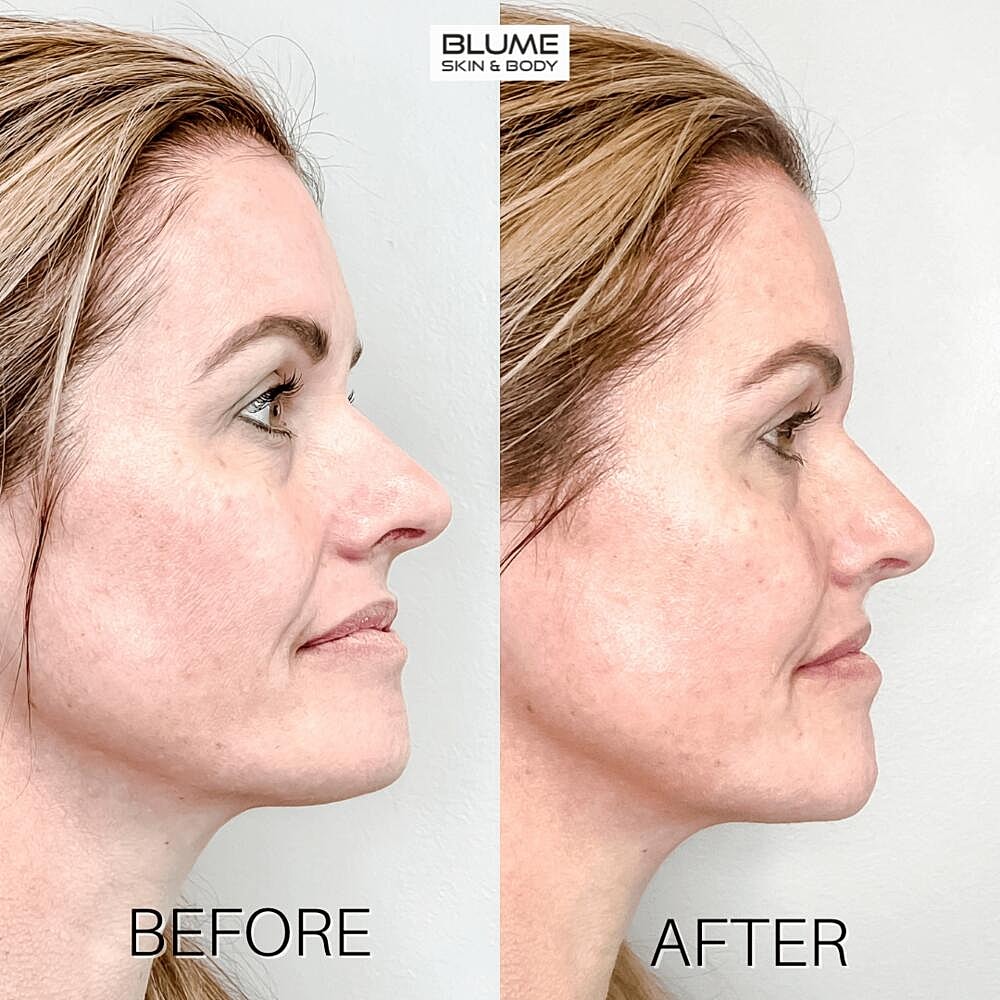 Dermal Fillers Before & After