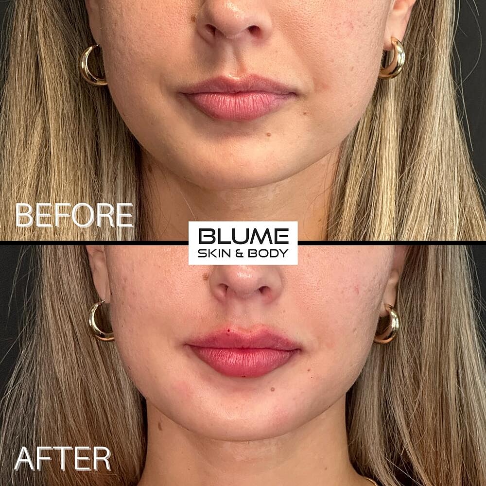 Dermal Fillers Before & After