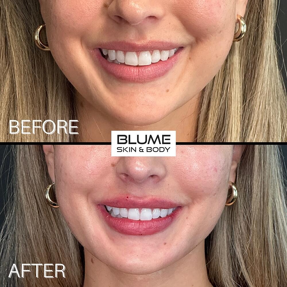 Dermal Fillers Before & After