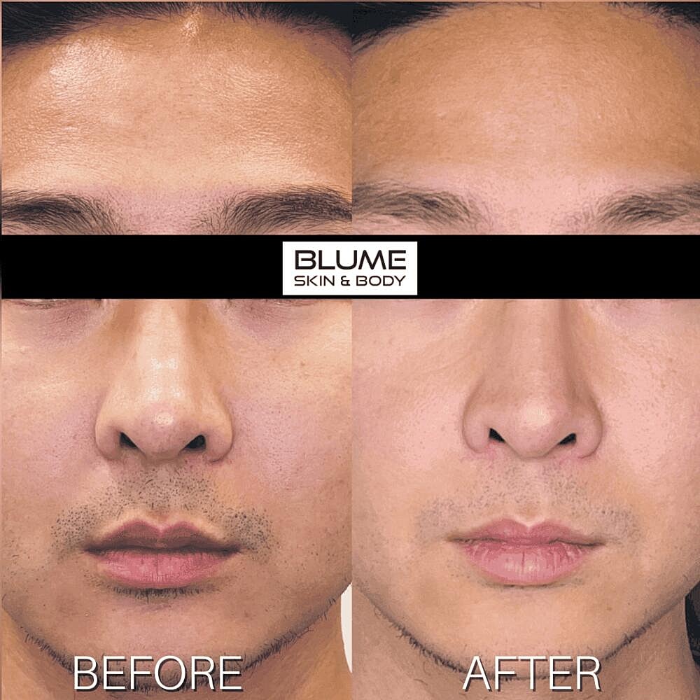 Dermal Fillers Before & After