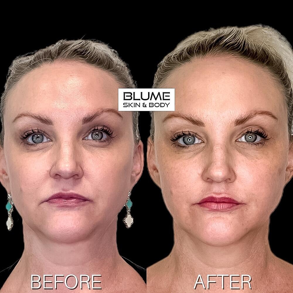 Dermal Fillers Before & After