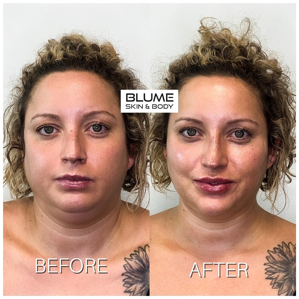 Dermal Fillers Before & After