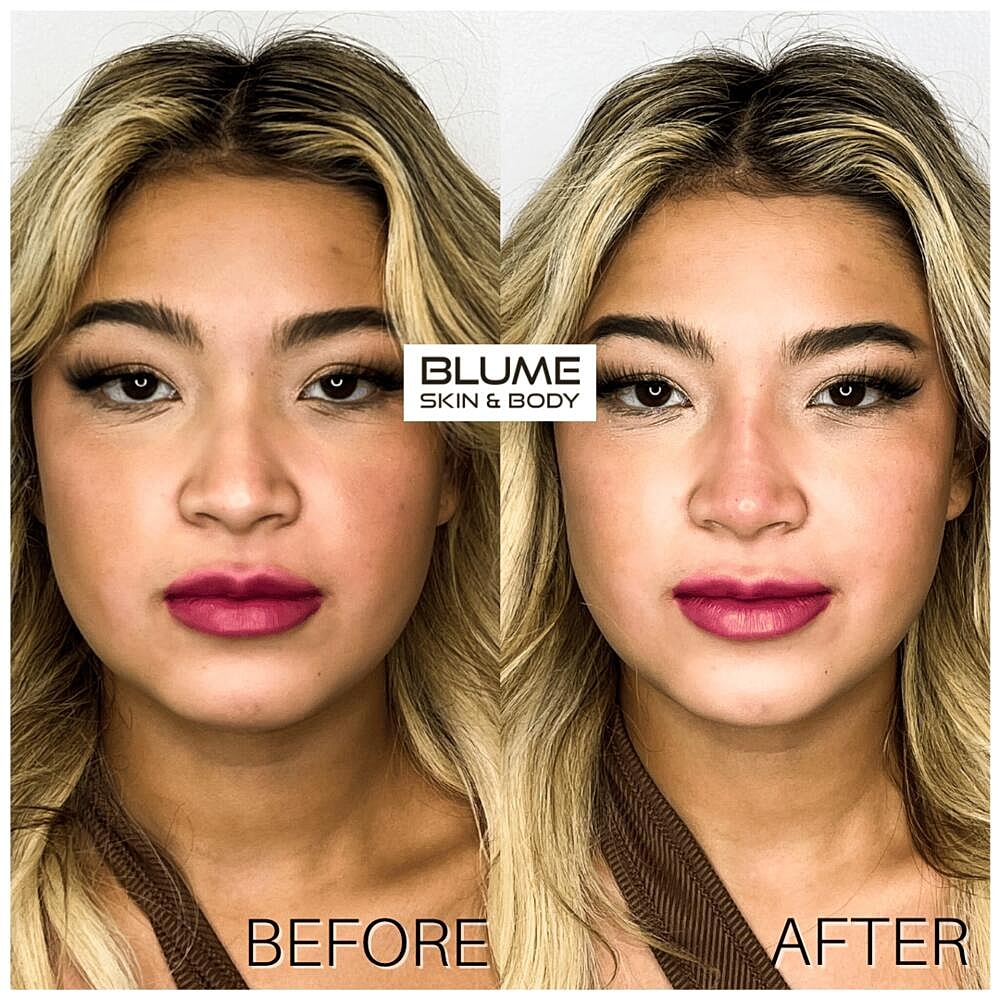 Dermal Fillers Before & After