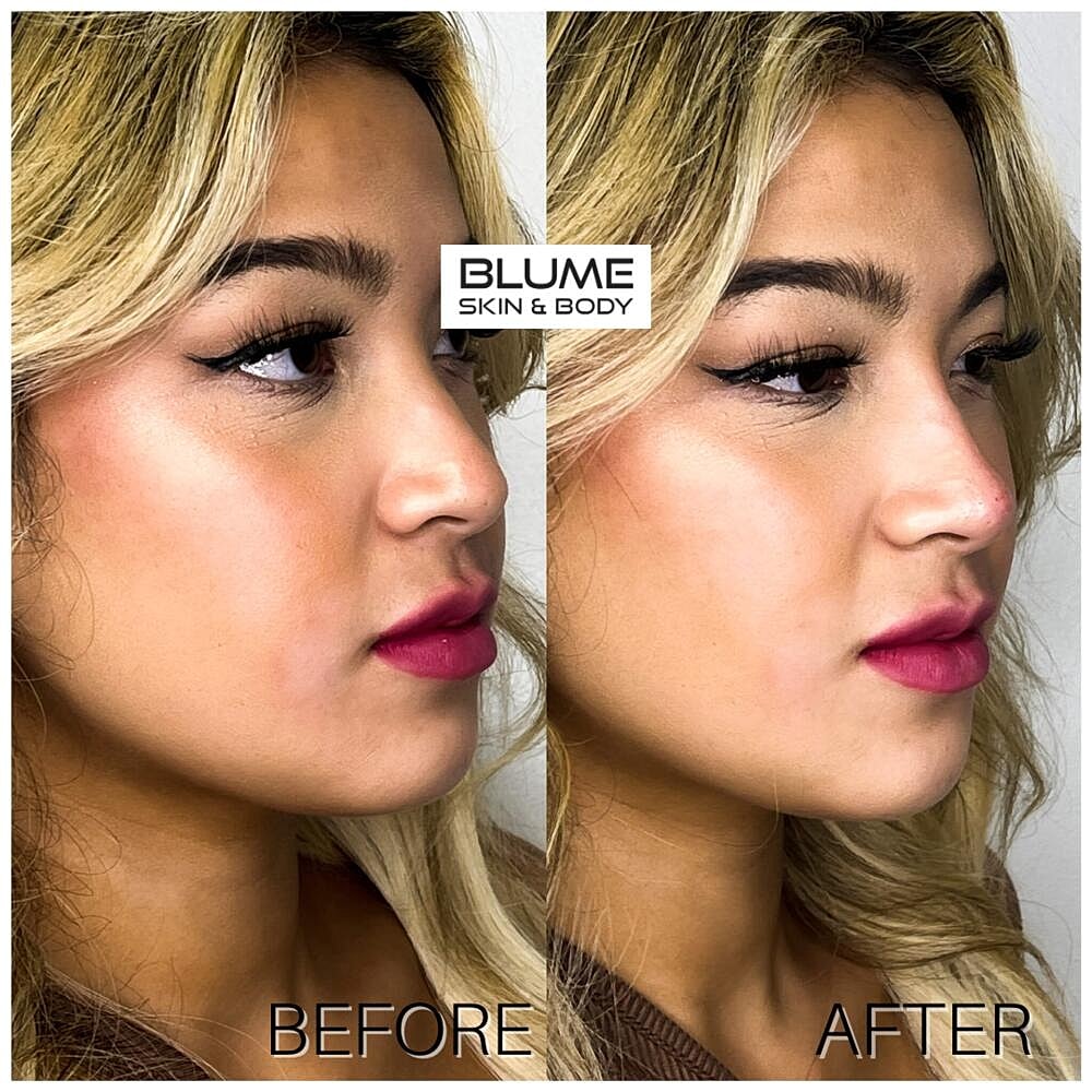 Dermal Fillers Before & After