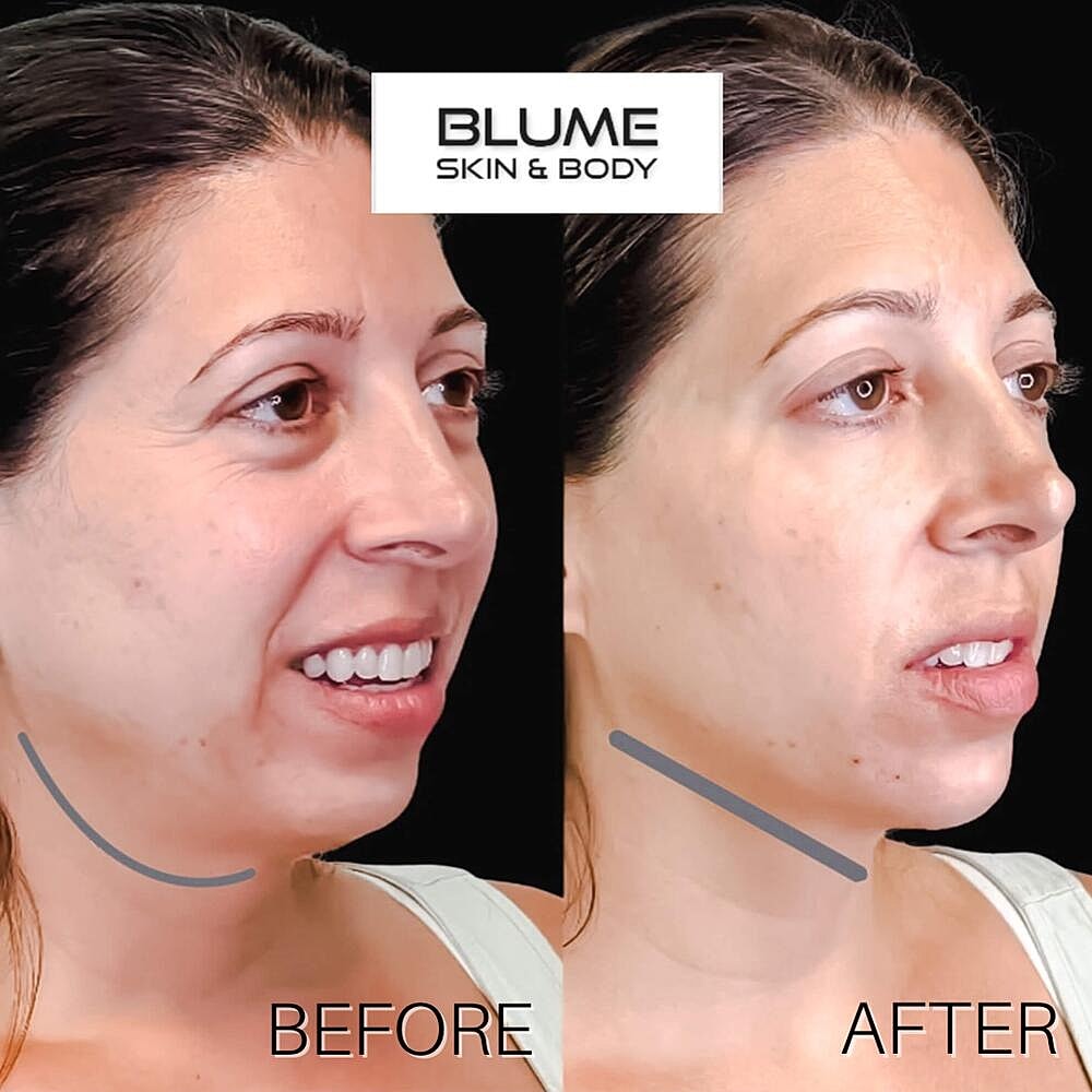 Dermal Fillers Before & After