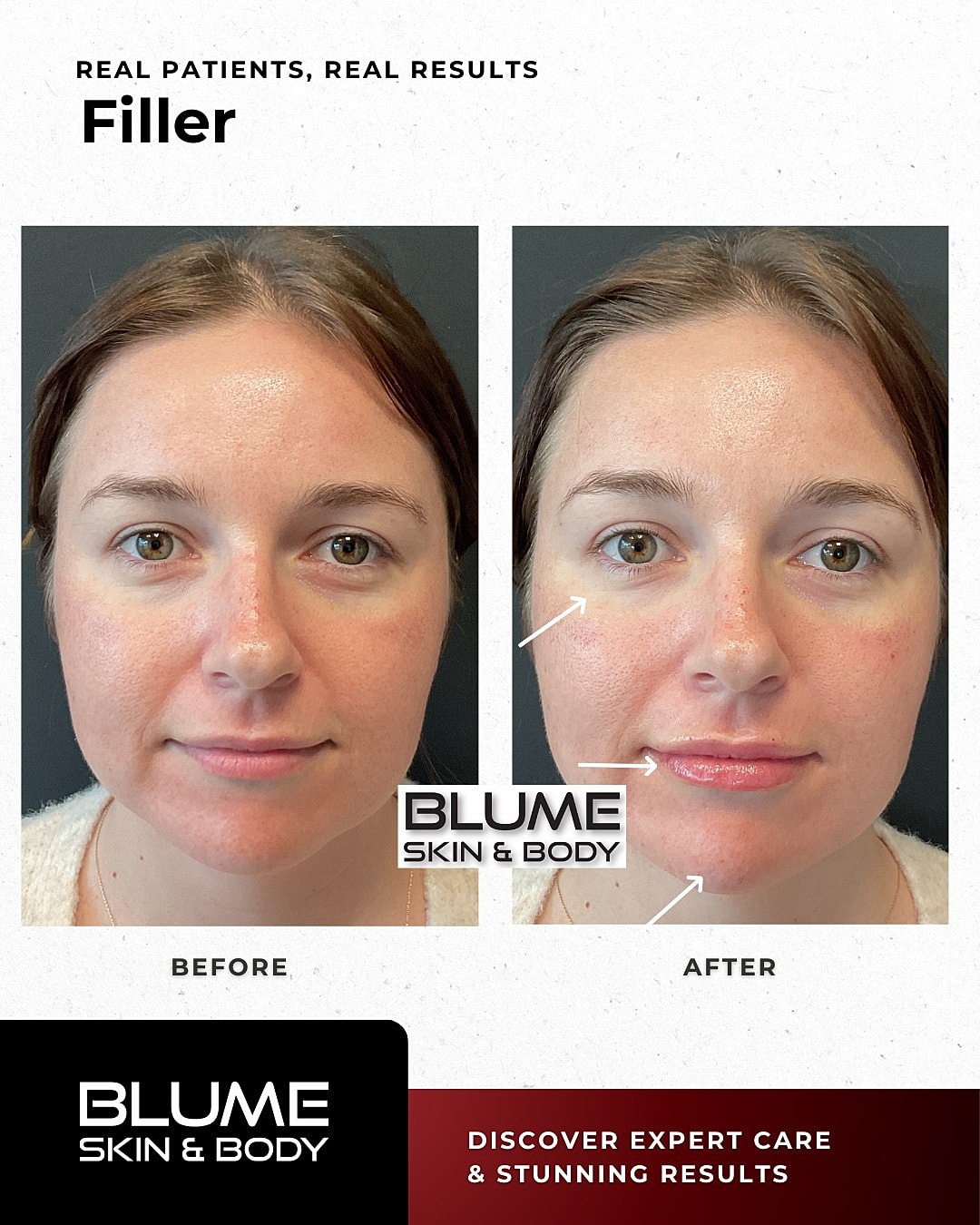Before and after filler treatment results.
