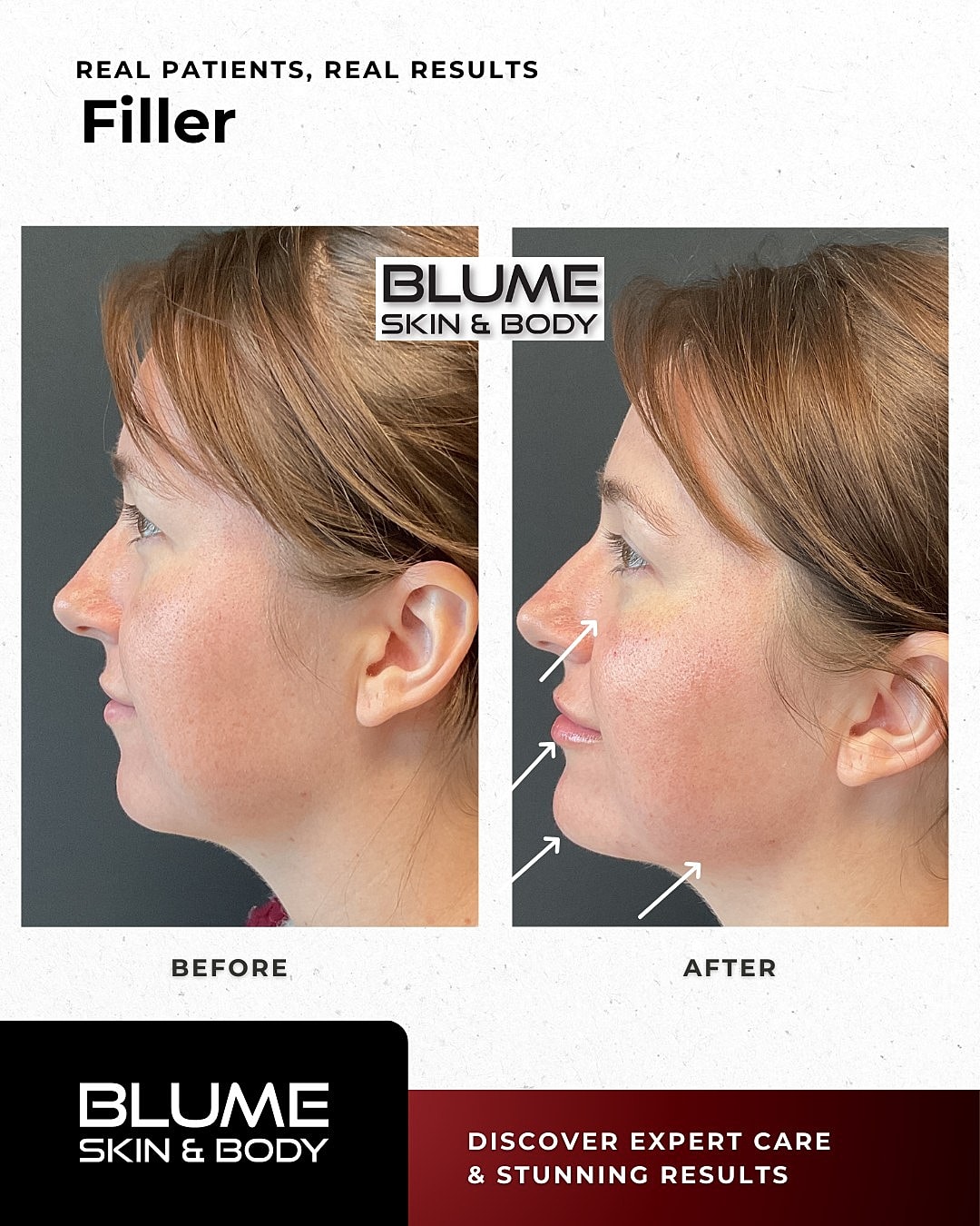 Before and after filler treatment results.