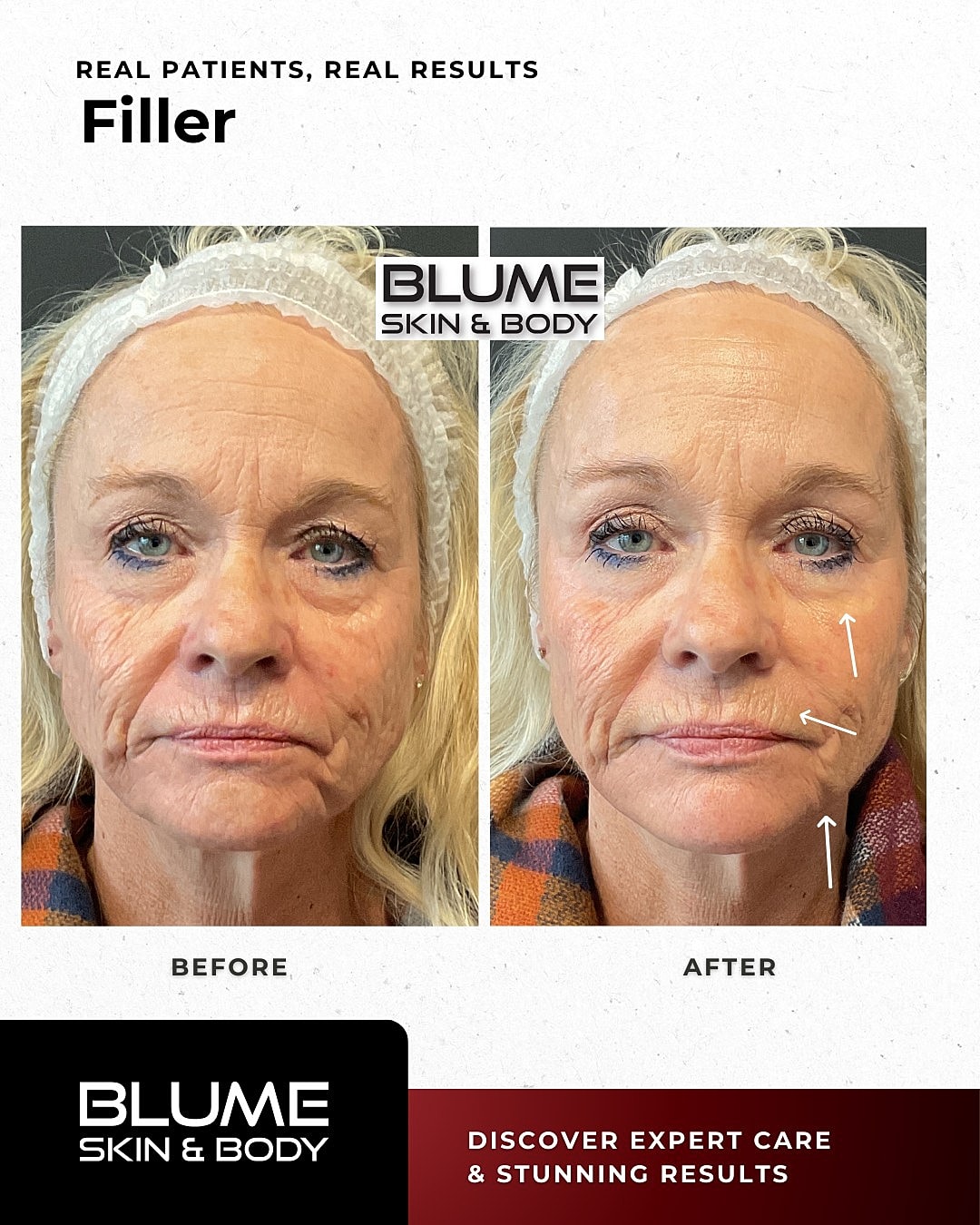 Before and after filler treatment comparison.