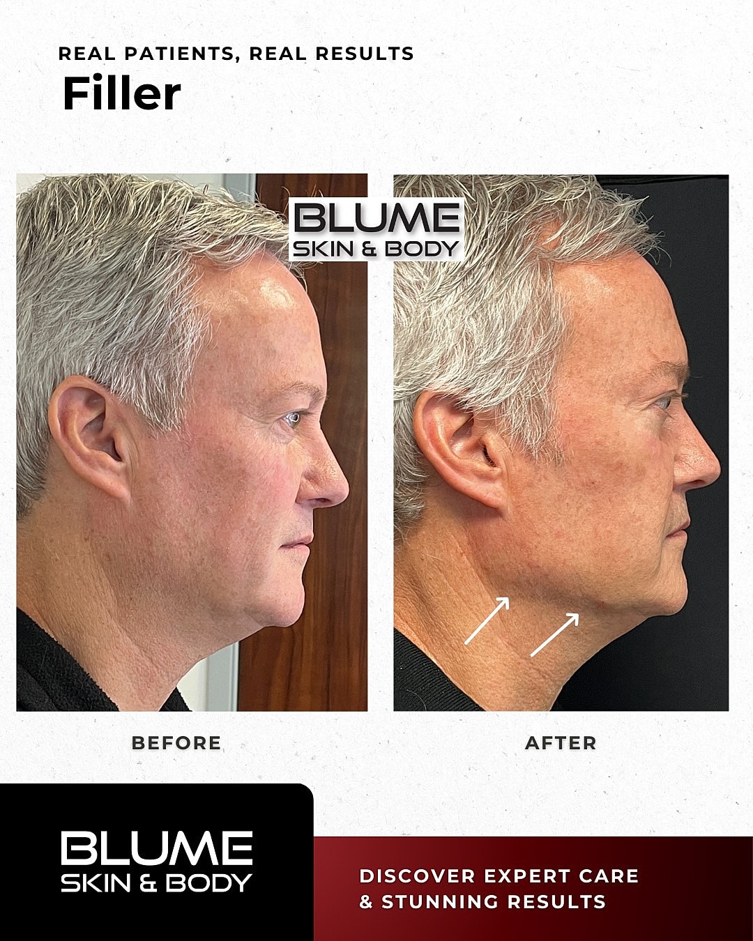 Before and after filler treatment results.