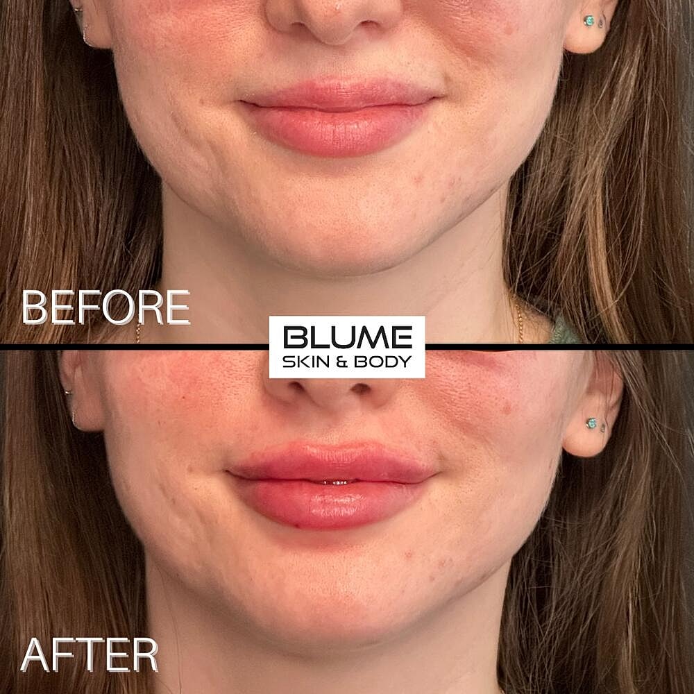 Dermal Fillers Before & After