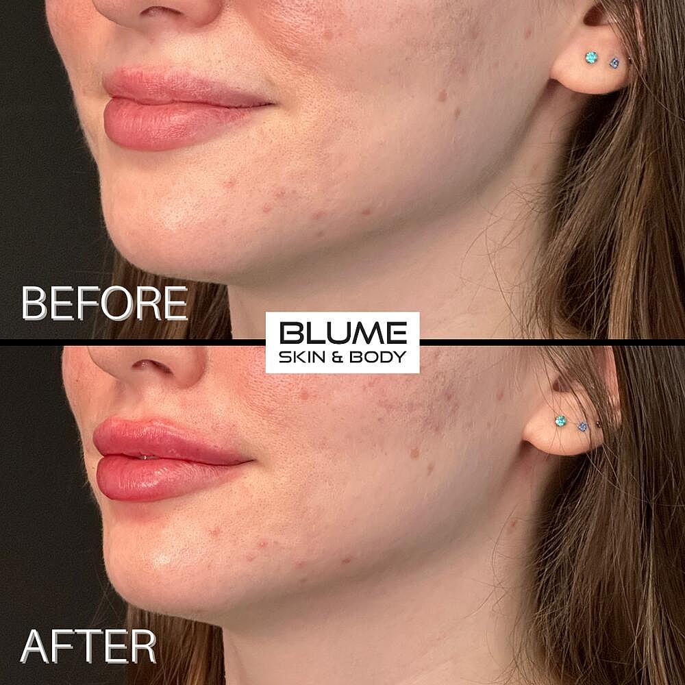Dermal Fillers Before & After
