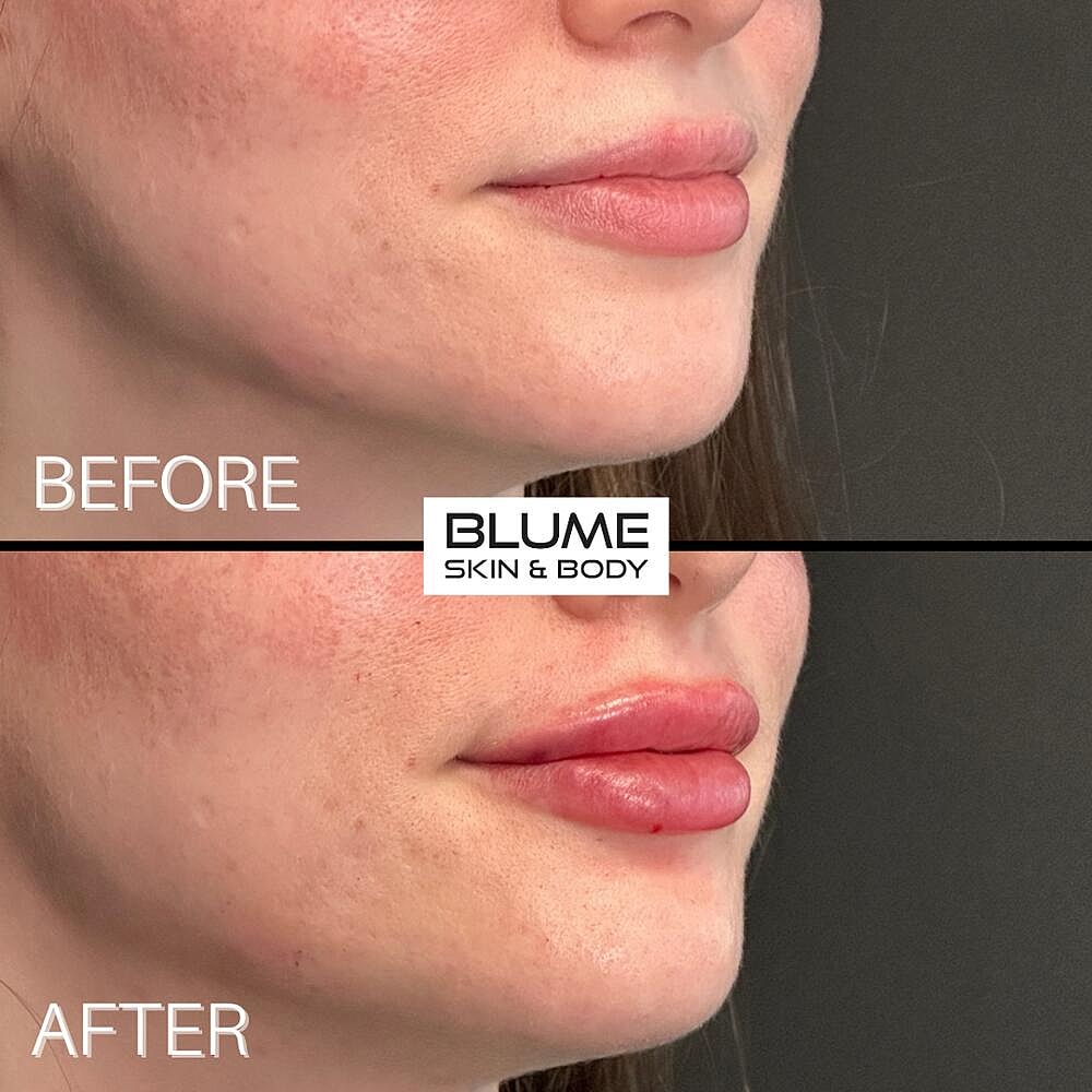 Dermal Fillers Before & After