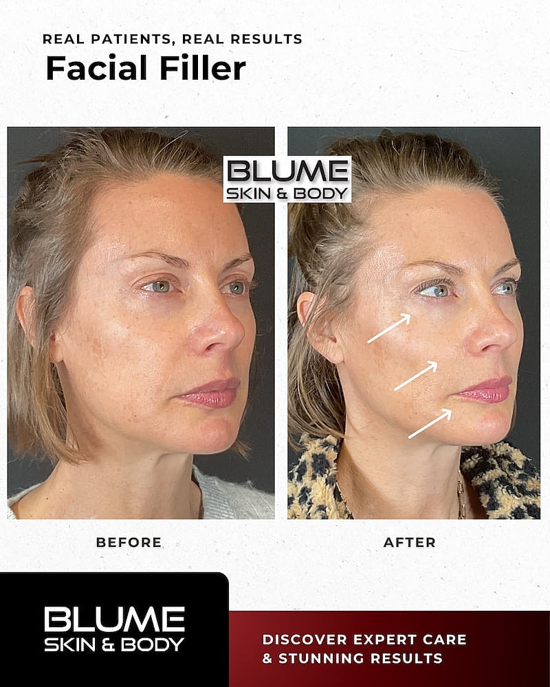 Dermal Fillers Before & After