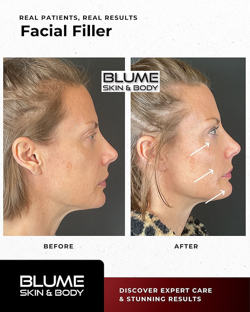 Dermal Fillers Before & After