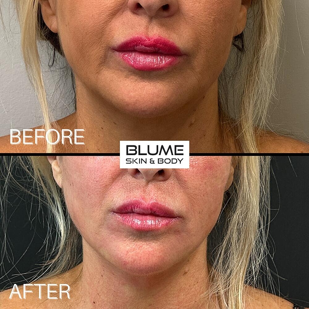 Dermal Fillers Before & After