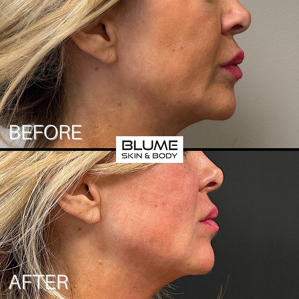 Dermal Fillers Before & After