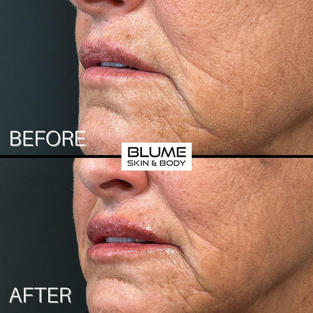 Dermal Fillers Before & After
