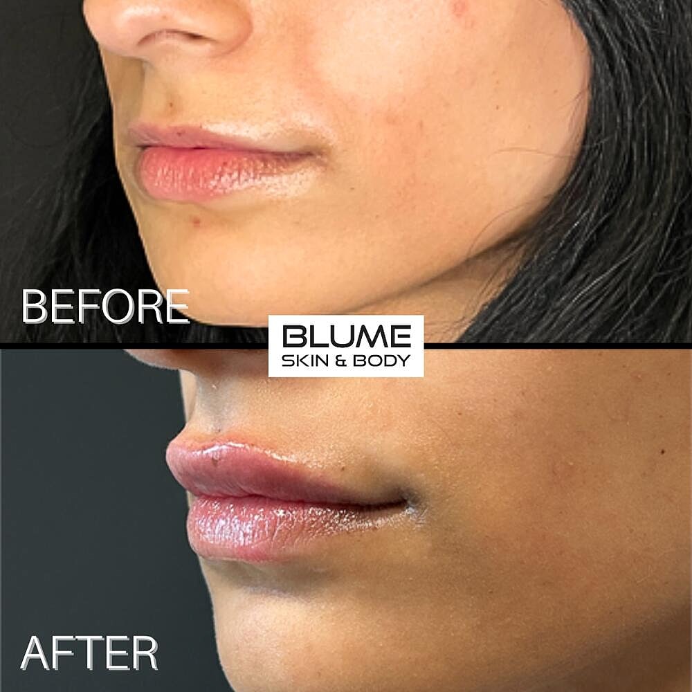 Dermal Fillers Before & After