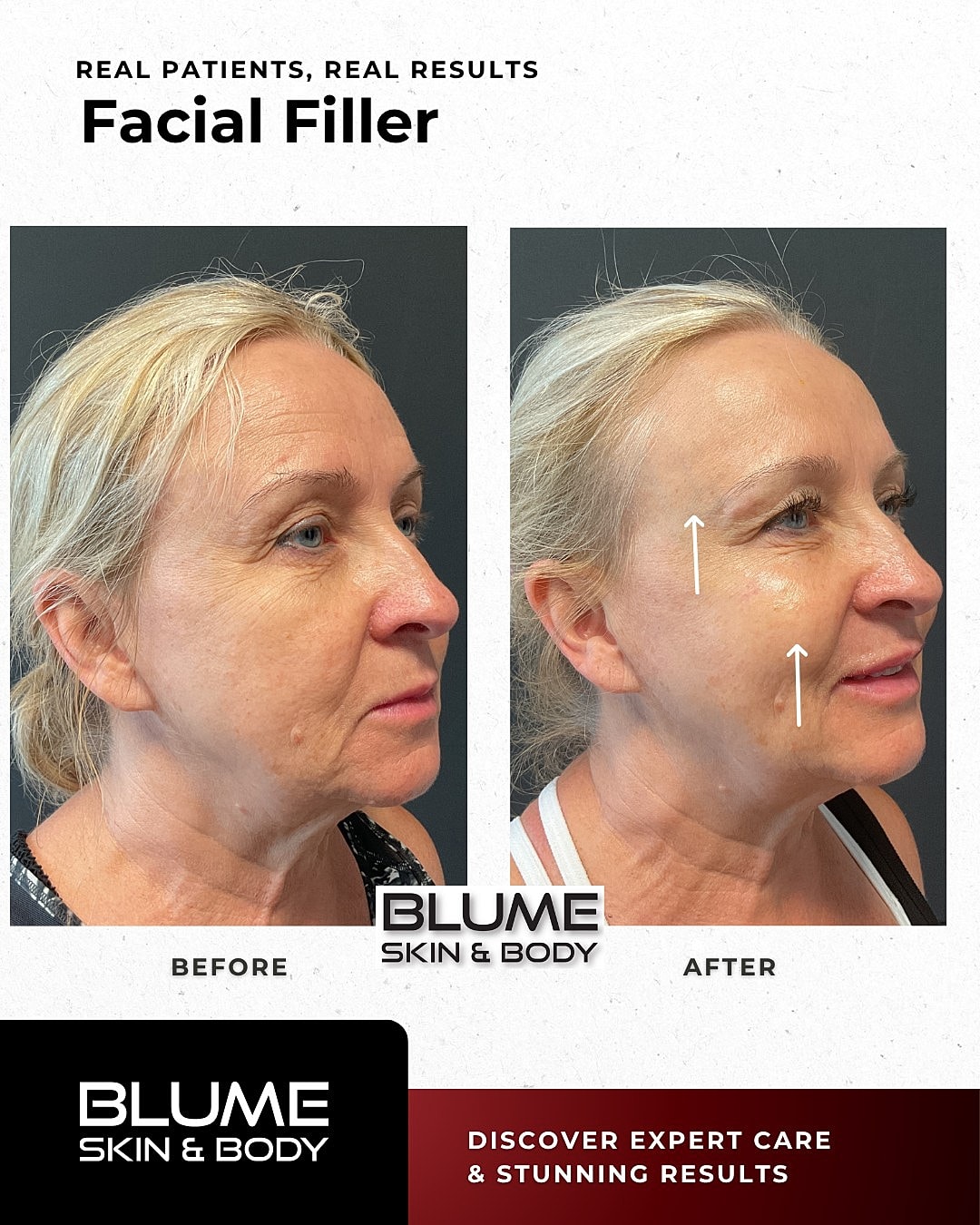 Before and after facial filler treatment comparison.