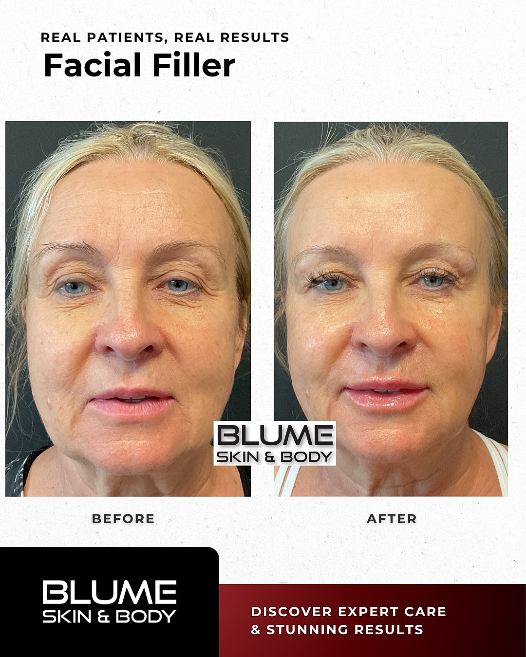 Before and after facial filler treatment comparison.
