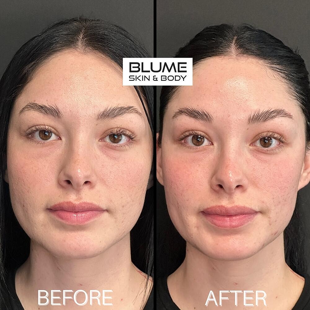Dermal Fillers Before & After