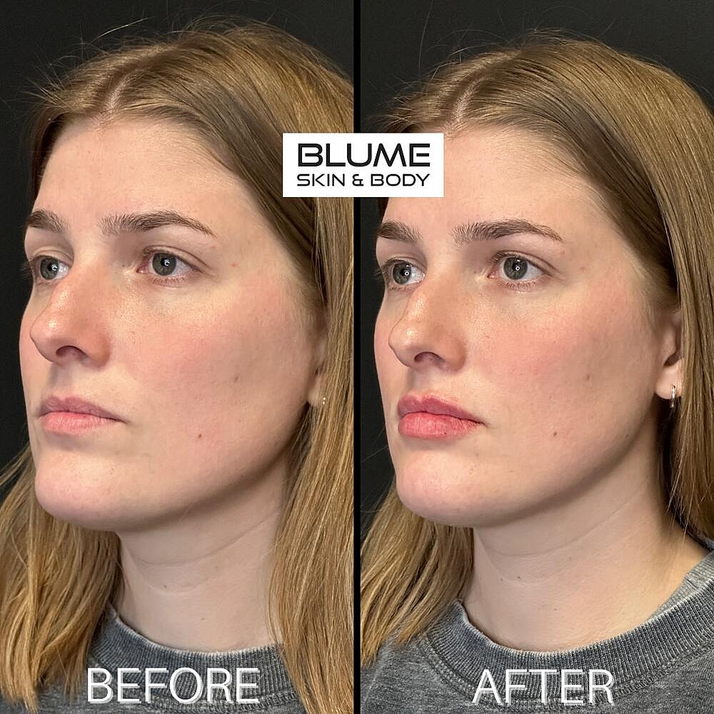 Dermal Fillers Before & After
