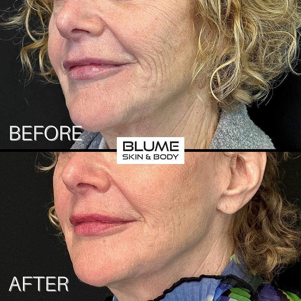 Dermal Fillers Before & After