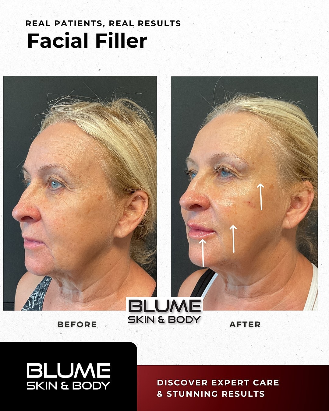 Before and after facial filler treatment results