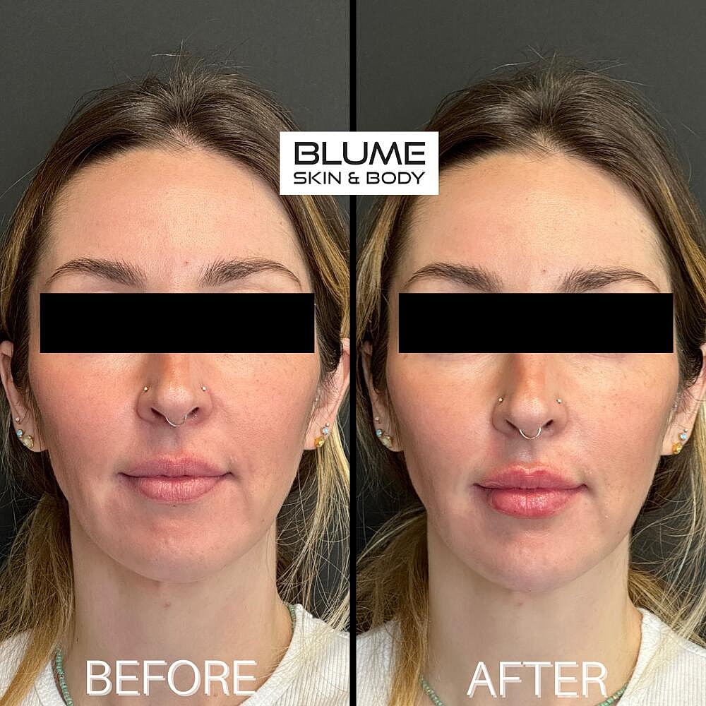 Dermal Fillers Before & After