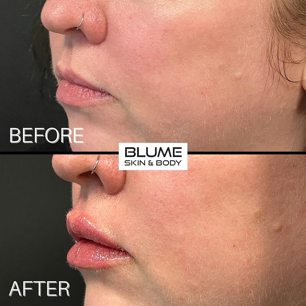 Dermal Fillers Before & After