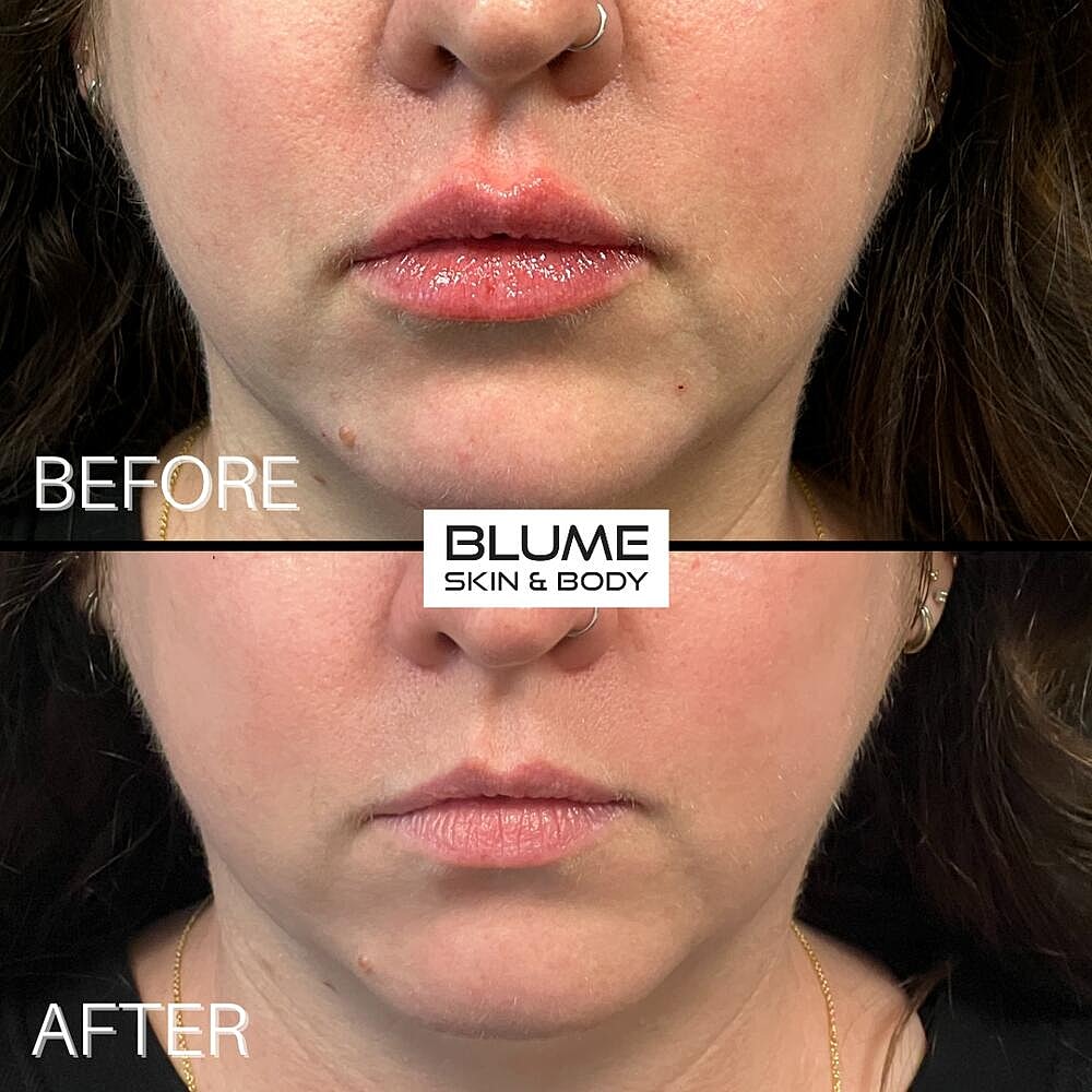 Dermal Fillers Before & After