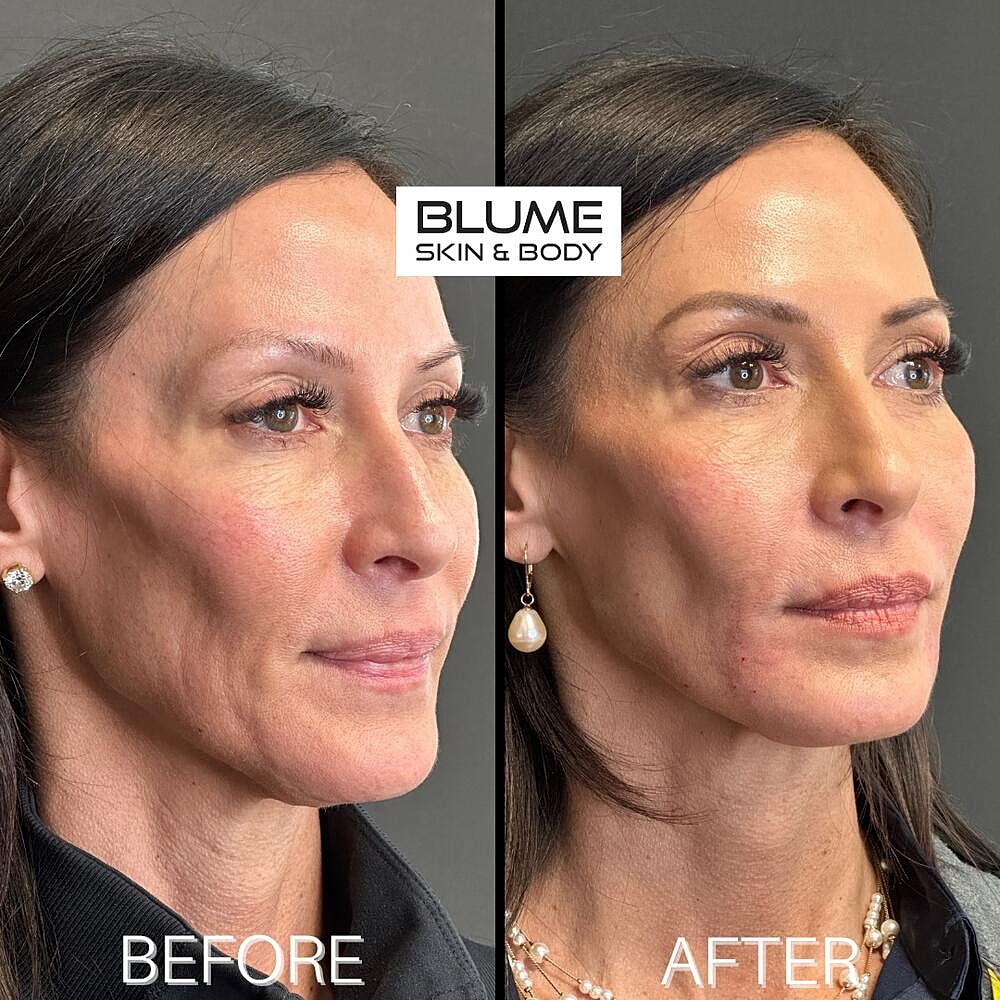 Dermal Fillers Before & After