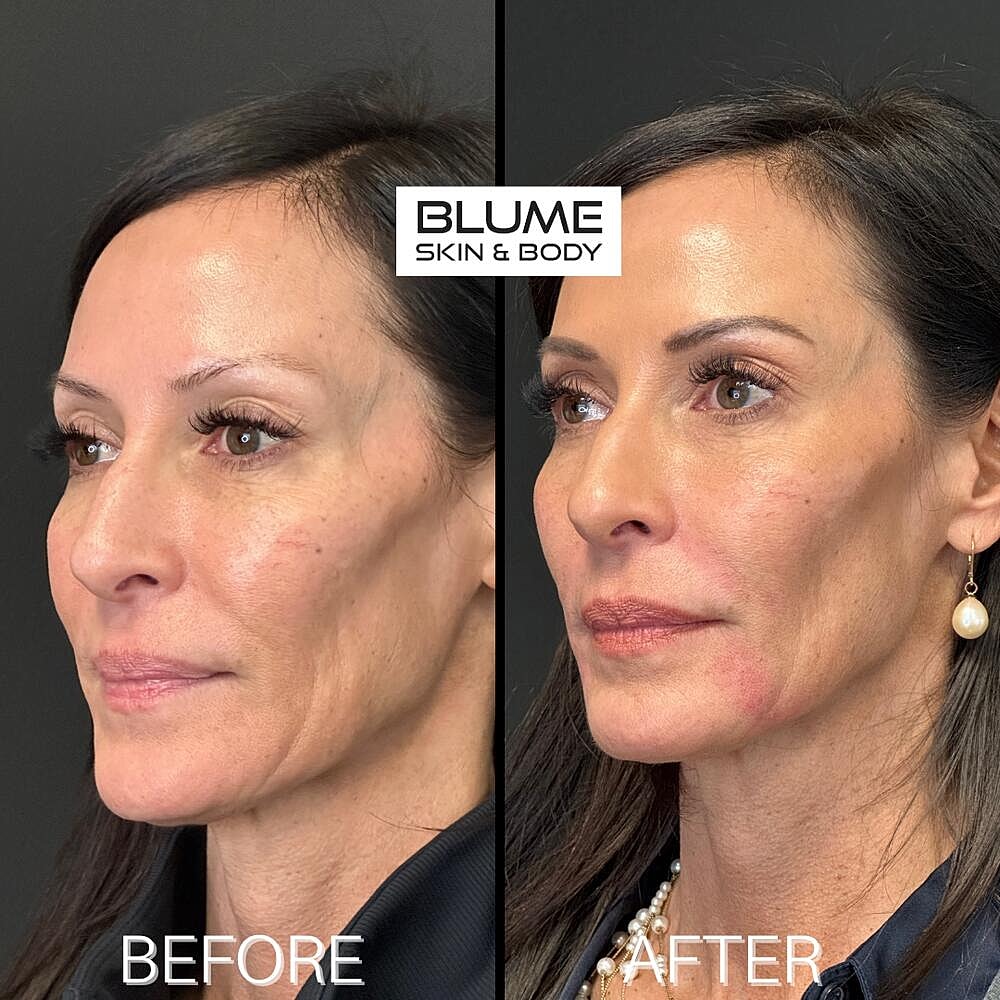 Dermal Fillers Before & After